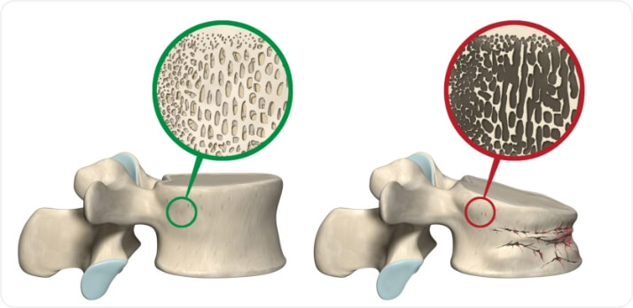 こだわりの骨粗鬆症治療